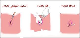 تمزق المهبل شكل المهبل بعد الولادة