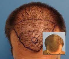 They want to have a hairline that restores the look that they had as kids. Hair Transplant Los Angeles Dr Sean Behnam Md