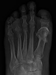 Image result for Osteomyelitis XRay