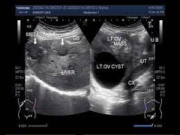 The purpose of this article is to review the ultrasound characteristics of ovarian and adnexal masses and to discuss the prediction of the likelihood of ovarian cancer based on these. Ultrasound Video Showing Metastatic Ovarian Cancer Youtube