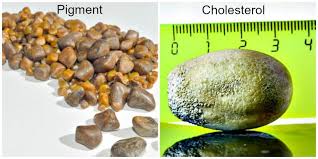 Used to suggest the number was unexpectedly large. How To Get Rid Of Gallstones Gallbladder Cleanse Cultured Palate