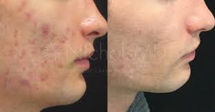Results from treatments will vary from person to person and results cannot be guaranteed. Fraxel Laser Archives Nicholsmd Of Greenwich