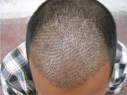 It involves conventional scientific diagnosis to chart and decide nutritional management. Services Hair Transplant Services From Delhi Delhi India By Dr Kandhari Skin Dental Clinic Id 5367086