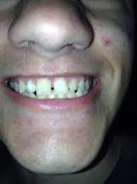 But you need to know how long do braces take to work so you can budget accordingly. How Long Will It Take To Close My Two Front Teeth Gap Photo