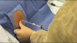 Do you mean that the doctors inserted a nasogastric tube to remove the fluids? 4 Buckets Of Fluid Removed From Abdomen Youtube