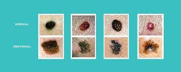 We may earn commission from links on this page, but we only recommend products we back. Understanding Skin Cancer At Ferrara Dermatology Of Grosse Pointe