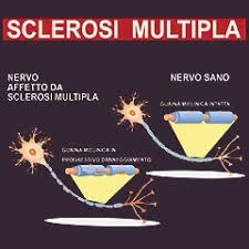 La sclerosi multipla, conosciuta anche come sclerosi a placche, è una malattia cronica demielinizzante di tipo autoimmune, che colpisce cervello e midollo spinale: Sclerosi Multipla Disturbi Cause E Cure Issalute