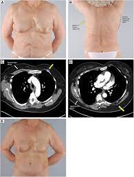 A case report on poland syndrome with breast cancer. Delayed Recurrent And Bilateral Breast Cancer In Patients With Partial Poland S Anomaly Report Of 2 Rare Cases And Review Of The Literature Clinical Breast Cancer