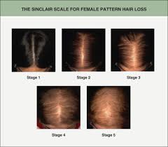 2nd stage of hair loss. Alopecias Plastic Surgery Key
