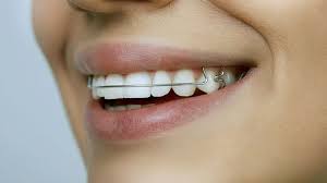 How to straighten your teeth without braces (with pictures). How To Straighten Teeth Without Braces Colgate Oral Care