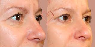 5 los efectos secundarios del botox (toxina botulínica). Inyeccion De Botox En Valencia Dra Villaverde