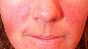 Check out results for your search Rosy Cheeks Rosacea Or Something Else Tips For Identification