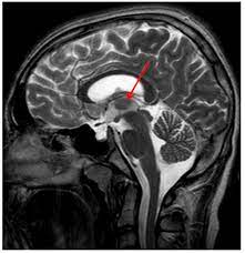 How Can Some People Live Without Pituitary Gland Empty Sella Syndrome Just Fine While Others Experience Serious Hormonal Issues From This Condition Quora