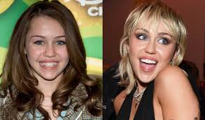 Celebrities With Braces Before And After | Famous Brace Faces