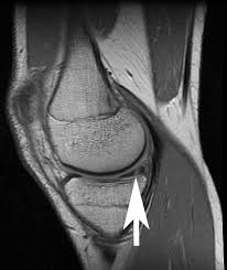 Mri View From The Side Of A Repairable Vertical Meniscus Tear Meniscus Tear Meniscus Surgery Knee Injury Recovery