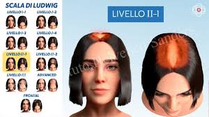 Quali sono le cause della perdita dei capelli? Caduta Dei Capelli E Calvizie Cause Tipologie E Rimedi