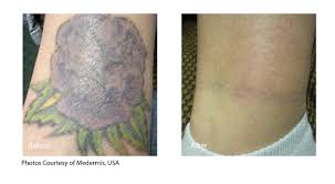 Tattoo removal in belfast, ni, guernsey & jersey. Everything You Need To Know Abouttattoo Removal