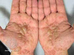 Image result for dyshidrosis