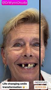 Good morning everyone!, Hope you’re having a good start to your weekend. I  wanted to share this amazing smile and life transformation for my patient.  My patient had much trouble finding a good dentist ...