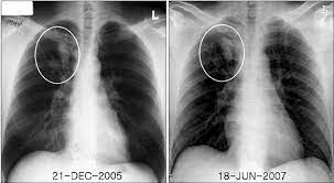 Ever wondered what ptb means? Chest X Ray Showing The Sequelae Of Pulmonary Tuberculosis Involving Download Scientific Diagram