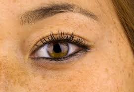 Image result for Freckled skin