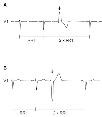 Premature ventricular contractions (pvcs) are extra, abnormal heartbeats that begin in the pvcs may be diagnosed during an electrocardiogram (ecg), which is a routine heart test, or through a some pvc symptoms can be managed through lifestyle changes — limiting caffeine, tobacco and. How To Detect Premature Ventricular Contractions Pvcs In A Ecg Signal Signal Processing Stack Exchange