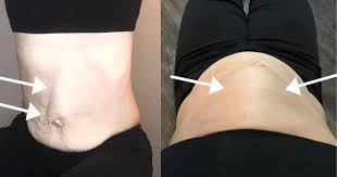 Maybe you would like to learn more about one of these? Diastasis Recti Symptoms In Simple Terms Mama Made Strong