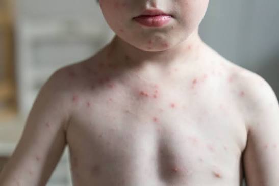 Os 8 principais sintomas de herpes zóster e como identificar| Padrão