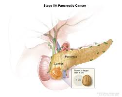Constipation is also a common problem. Chemotherapy Change Improves Pancreatic Cancer Outcomes National Cancer Institute