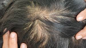 One of the many symptoms of iron deficiency anemia is hair loss. 7 Things Your Hair Reveals About Your Health Everyday Health