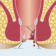 Hemorrhoid Disease – Rougine Darou