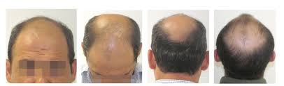 Here's a brief history of hair. Before The Fue Hair Transplant Maral Hair