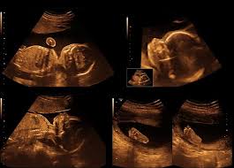 Gambar yang dihasilkan saat pemeriksaan ultrasound 3d umumnya diambil pada berbagai sudut dan kemudian disatukan untuk membentuk rendering tiga dimensi. Ini Dia Perbedaan Usg 2d 3d 4d Dan 5d Yang Ibu Hamil Perlu Tahu Bukareview