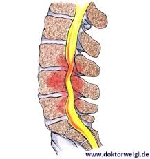 Spinalkanalstenose Ist Das Gefahrlich Was Kann Ich Selber Tun