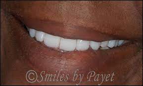 Removable Dentures Implant Overdentures Charlotte Dentist