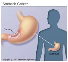 Learning about medical care for stomach cancer can help you take an active part in making choices about your care. Stomach Cancer Quick Health Info
