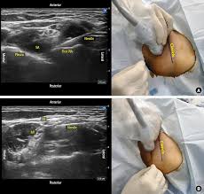 Image result for Superior Trunk Block