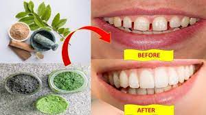 Dental bonding dental bonding, or cosmetic bonding, is the easiest, quickest, and most economical way to fix a gap between teeth. How To Fix Gap Between Teeth Naturally At Home Without Braces Health Pavilion Bright Side Youtube