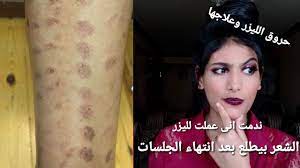 تجربتى مع ازالة الشعر بالليزر ندمت انى عملت ازالة شعر بالليزر youtube