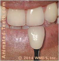 One of the causes of temporary crown pain may be related to the adverse reaction of the nerve in the affected teeth to the dental adhesive used to attach the dental cap. Steps Of The Dental Crown Procedure Preparation To Cementation