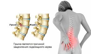 Zashemlenie Sedalishnogo Nerva Kak Izbavitsya Ot 2 H Ego Glavnyh Prichin Personalnaya Medicina Yandeks Dzen
