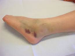 Rehabilitation after injury to the medial collateral ligament of the knee phase 1: Sprained Ankle