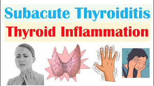 Image result for Thyroiditis