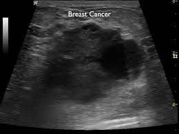 Breast cancer is the second leading cause of death for women all over the world. Beneath The Surface A Guide To Breast Imaging Breast360 Org The American Society Of Breast Surgeons Foundation