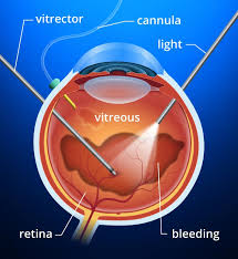 4 meanings of eua abbreviation related to surgery Vitrectomy And Vitreoretinal Procedures Allaboutvision Com