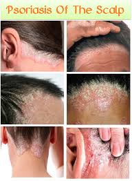 Maybe you would like to learn more about one of these? Scalp Psoriasis Of The Scalp Psoriasis Remedies Scalp Scalp Psoriasis Treatment Scalp Psoriasis
