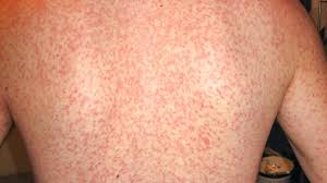 Signs and symptoms of mononucleosis may include: Is That A Mono Rash How To Know If That Rash Means Mono