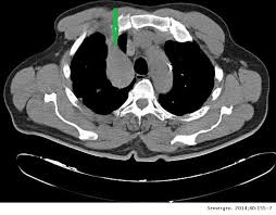 They usually start in the lining of the in later stages the tumors sometimes produce hormones that can cause carcinoid. Tumor Carcinoide Atipico Broncopulmonar Como Hallazgo En Una Radiografia De Torax Medicina De Familia Semergen