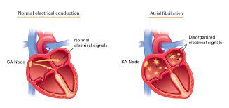 What Is Sick Sinus Syndrome