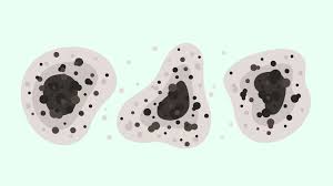 Se le ha llamado zigomicosis, mucormicosis, ficomicosis y, últimamente, infección por el hongo negro. Que Es El Hongo Negro Y Por Que Preocupa En Pandemia Salud Con Lupa